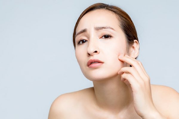 Nổi Mụn Do đăp Mat Na Quá Lâu